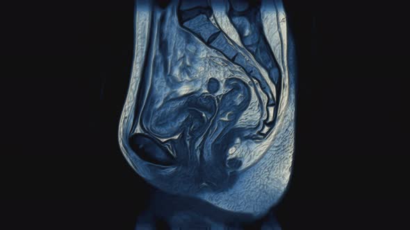 Voluminous Color MRI of the Female Pelvic Organs Abdominal Cavity Gastrointestinal Tract and Bladder