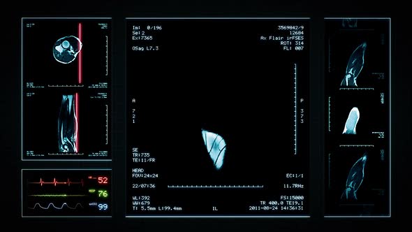 Loopable Arm MRI Scan. Blue. 3 videos in 1 file. Animation showing top, front, lateral view and ECG.