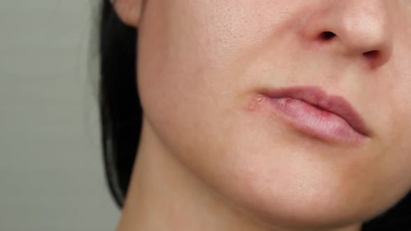 Female Face Close-up with Herpesvirus Disease. A Woman Holds a Tablet in Her Hand, Closing the