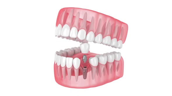 Dental implant placement over white background