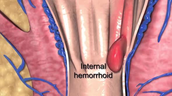 Internal hemorrhoids lie inside the rectum
