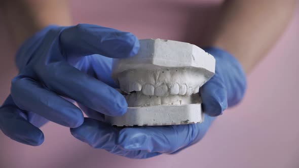 Gypsum Model of the Teeth Before Installing the Bracket System