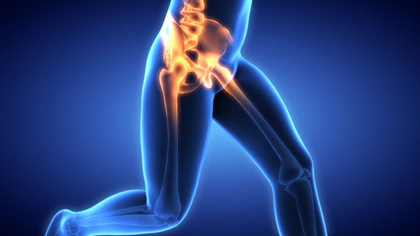 Hip Painful Skeleton X-Ray - Medical Concept