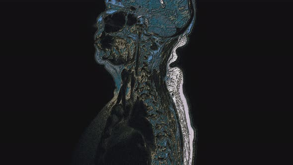 Postoperative Bulk Multicolored MRI of Female Organs for the Detection of Metastases