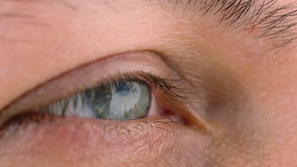 Female Eye with Keratoconus Thinning of the Cornea