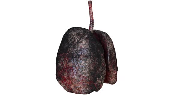 Human Lungs of Smoker