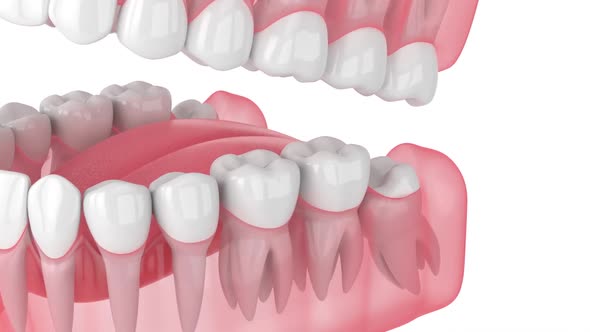 Jaw with mesial impacted wisdom tooth