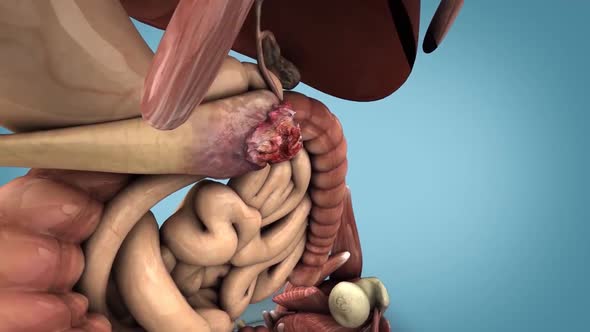 pancreatic cancer  medical animation