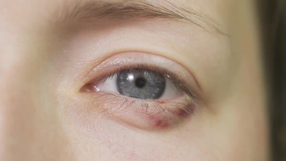 Young Woman with Hordeolum Disease in the Eye