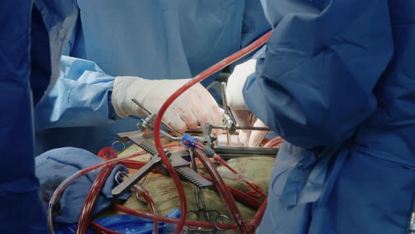 Surgeons working during open heart surgery, close up on hands and instruments.