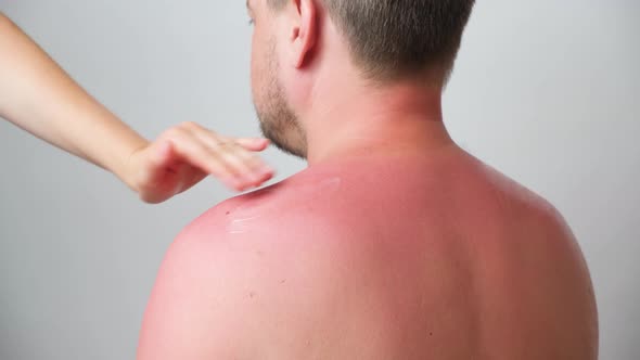 Applying Therapeutic Ointment to the Skin of a Person with a Sunburn Closeup