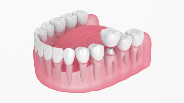 Jaw with dental crown embed on reshaped tooth over white background alt