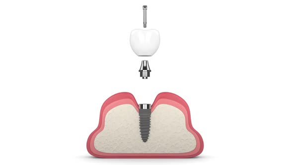 Dental implant placement into human gums over white background alt