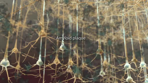 Amyloid Plaques. The beta-amyloid protein involved in Alzheimer's disease