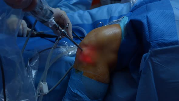 Knee Surgery, Arthroscopy