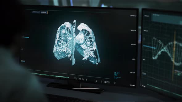 Medical Doctor Examines Patients Lung Structure Detects A Large Cancer Tumor