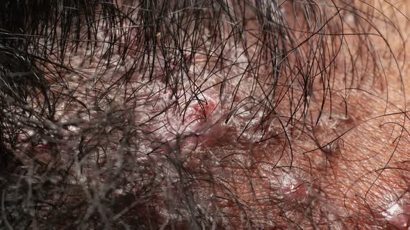 Infected Human Skin Texture