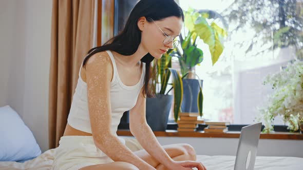 Young Lady in Glasses with Uneven Pigmentation Working on Laptop Sitting on Bed at Home Slow Motion