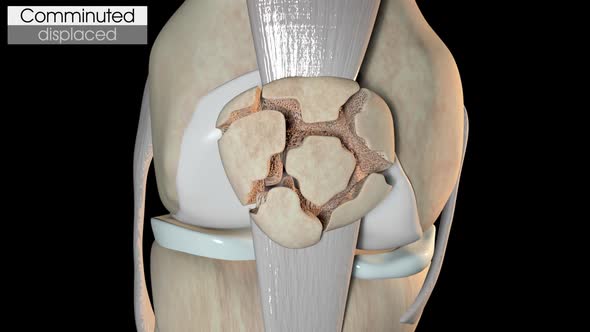 Patella Fracture   Comminuted Displaced