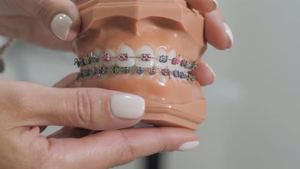 Model of the teeth the bracket system. Jaw with teeth and orthodontic braces. Doctor Orthodontist.