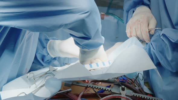 Surgeons working during open heart surgery, close up on hands and instruments.