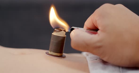 Woman undergo moxibustion therapy on her body