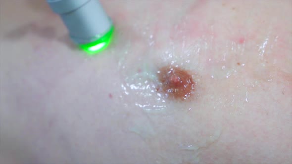 Close up nipple depilation laser hair removal procedure treatment