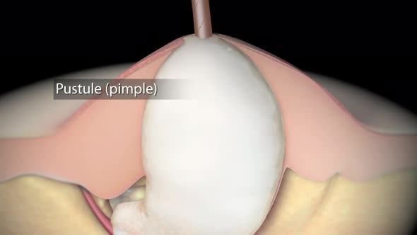 Acne And Pimples, Stages Of Development, Graphic Animation