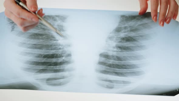 Lungs Xray Closeup