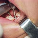 Close Up of a Metal Core Getting Installed Into Oral Cavity - VideoHive Item for Sale