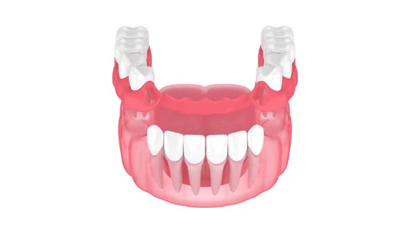 Jaw with removable partial denture isolated over white background