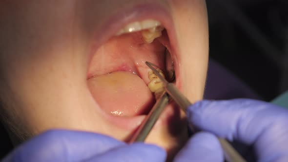 Dentist Examines Patient's Tooth with Black Cavity on It Using Dental Tools and Mirror. Tooth Decay