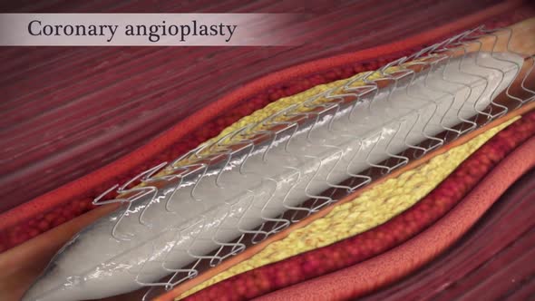 Coronary angioplasty opens narrowed coronary arteries.