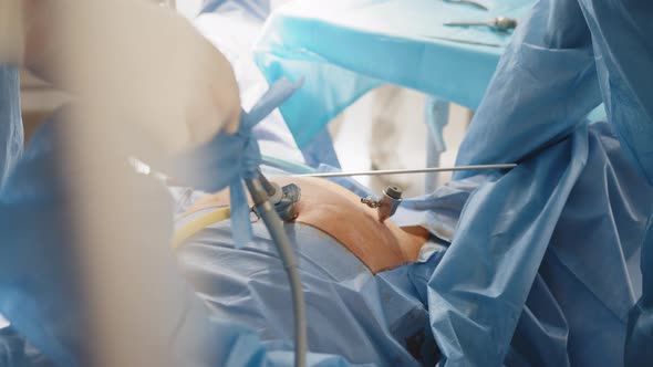 Close Up of Hands of Surgeons Team During Operation Uterus Removal with Surgical