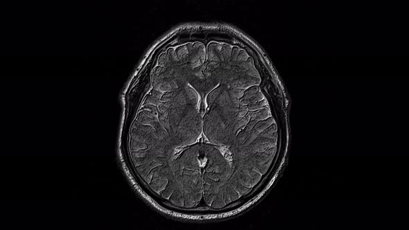 Voluminous MRI Scans of the Brain and Head To Detect Tumors. Diagnostic Medical Tool