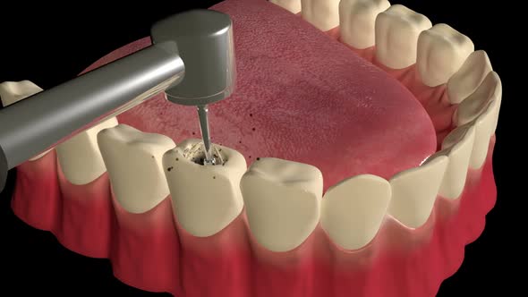 Tooth Cavity Filling Procedure