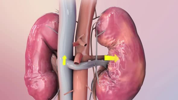 Damage to the kidneys as a result of high potassium levels in the blood.