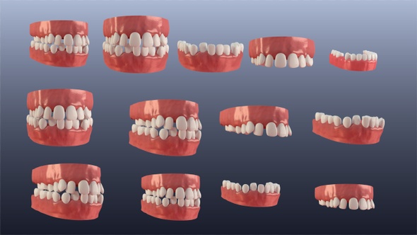 Teeth With Braces