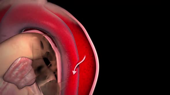 Aortic aneurysm and aortic dissection