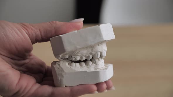 Gypsum Model Teeth Before Installing Bracket System