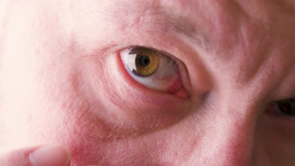 Close Up of Man's Face Showing Red Bloodshot Eye