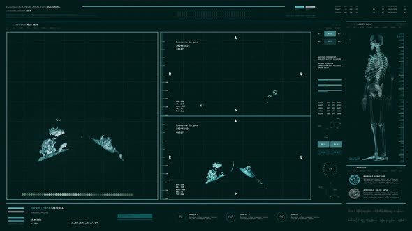 High Tech Medical Diagnostic Computer Scanning Lungs Diagnoses Pneumonia alt