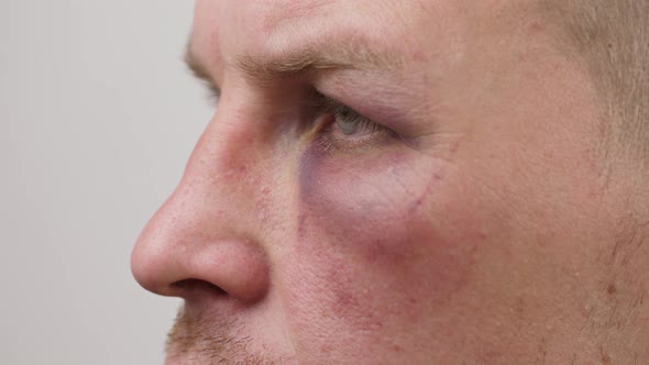 Man with Bruise Uner Eye