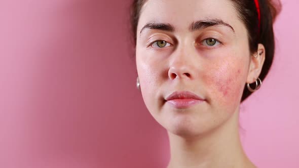 Portrait of a young Caucasian woman shows inflammation and couperose on her face. Pink background