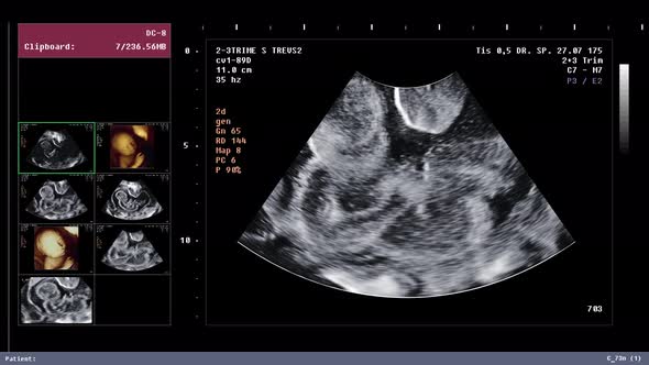 Using ultrasonography equipment for a prenatal diagnostic test at a hospital alt