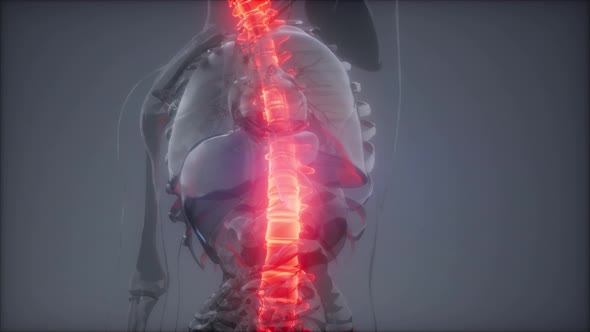 Backache in Back Bones