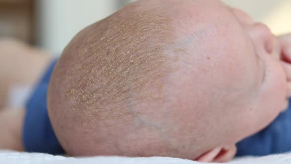 Closeup View of Cradle Cap or Seborrhea on the Infants Head