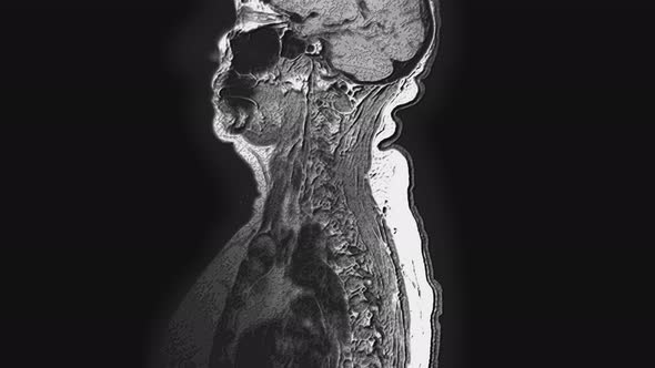 Postoperative Voluminous MRI of Female Organs for the Detection of Metastases