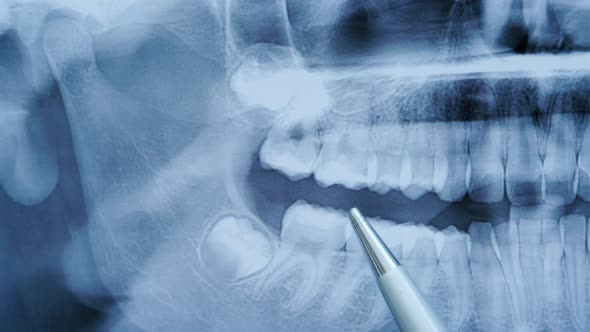 Dentist Examines a Panoramic Xray of the Teeth Shows the Problem Teeth on the Xray of the Teeth
