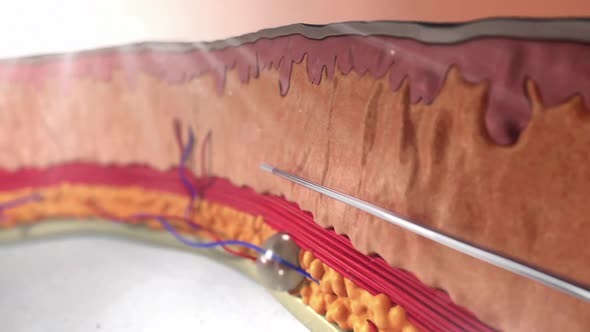 3d animation of hyaluronic acid injection with needle. Section of skin epidermis structure
